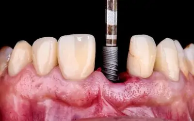 Todo lo que debes saber de los implantes dentales