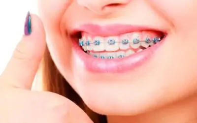 ¿Cuánto tiempo hay que usar los retenedores después de quitarte la ortodoncia?