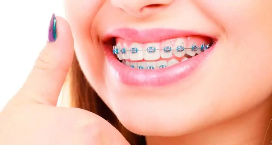 ¿Cuánto tiempo hay que usar los retenedores después de quitarte la ortodoncia?